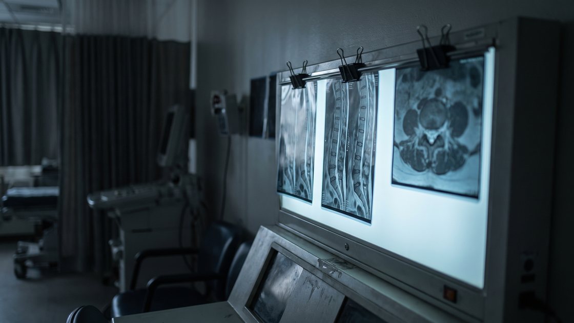 Spinal MRI films on a lightbox in a darkened radiology room